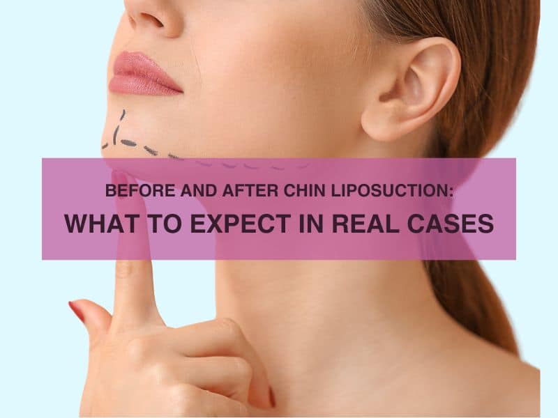Before and After Chin Liposuction What to Expect in Real Cases