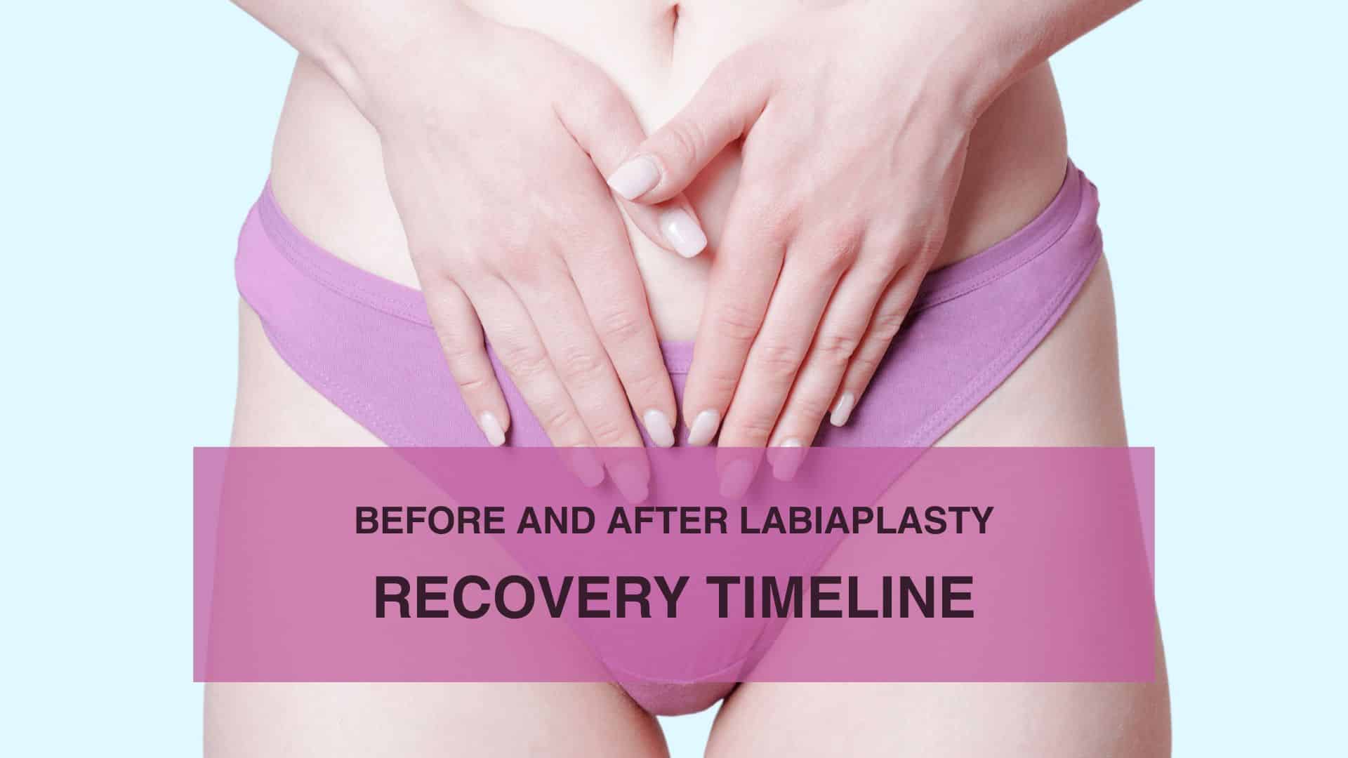 Before and After Labiaplasty Recovery Timeline