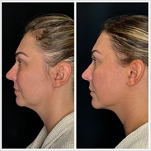 Before and after Chin Lipo Chicago