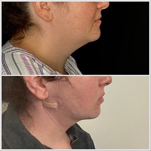 Chin Lipo Before and after Chicago
