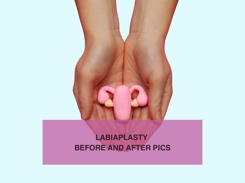 Labiaplasty Before and After Pics