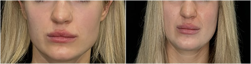 Lip Fillers Before and After Chicago