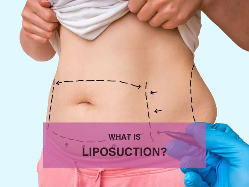 What Is Liposuction