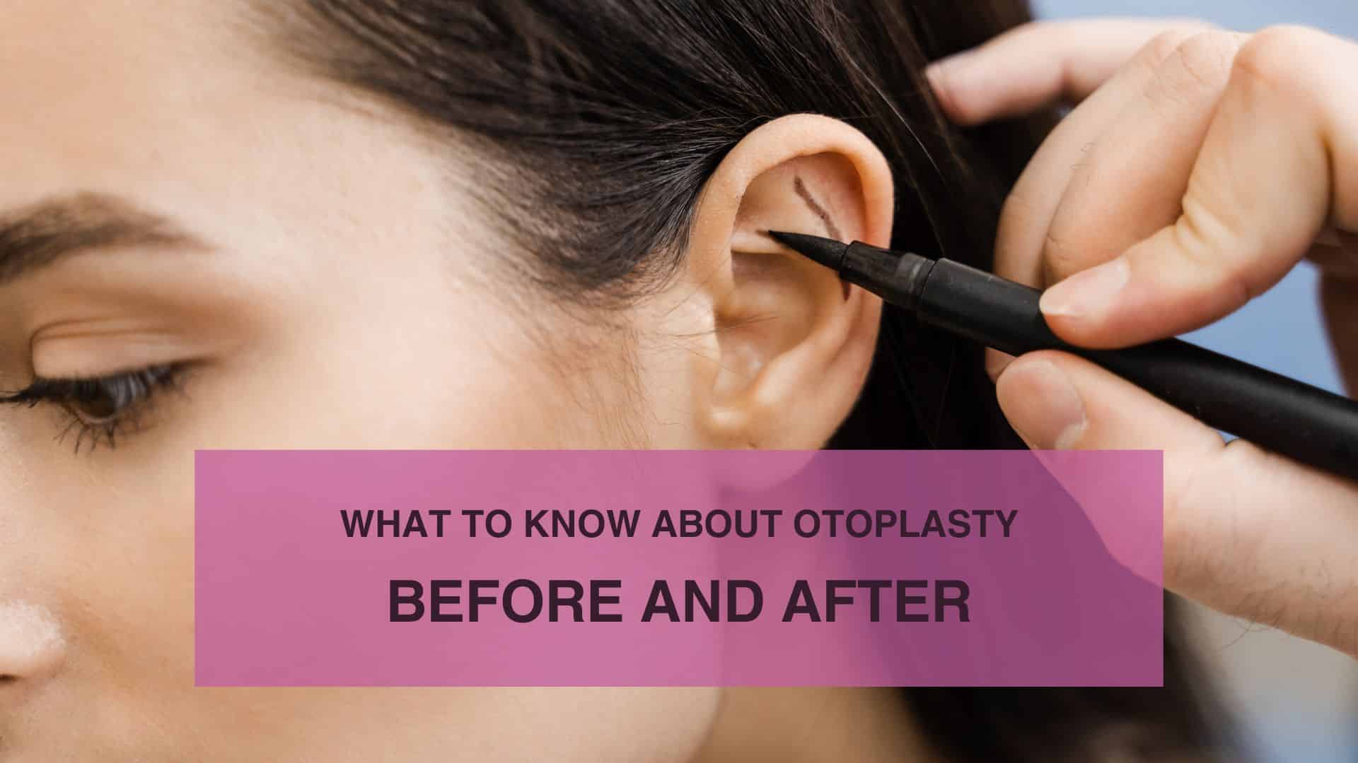 What to Know About Otoplasty Before and After