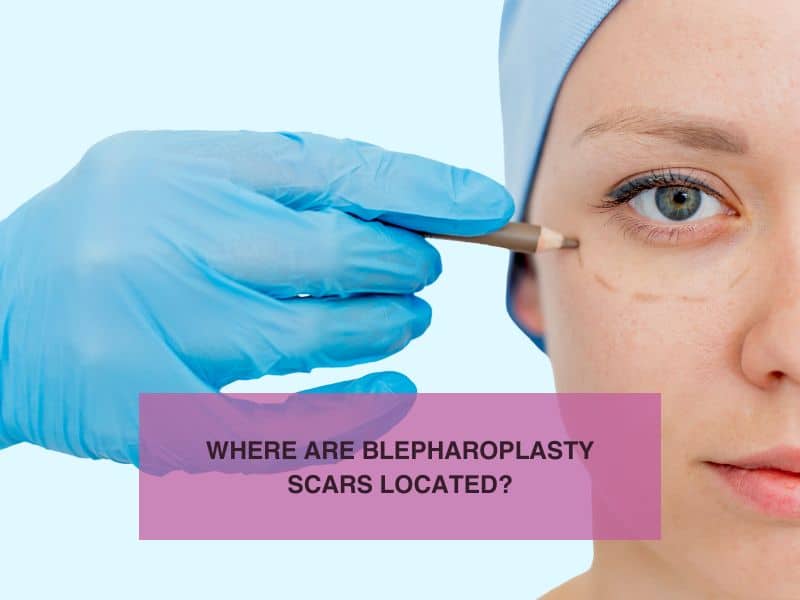 Where Are Blepharoplasty Scars Located