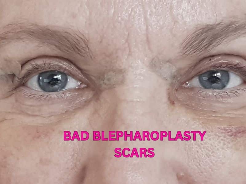 bad blepharoplasty scars