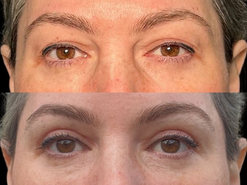 before and after eyelid surgery chicago