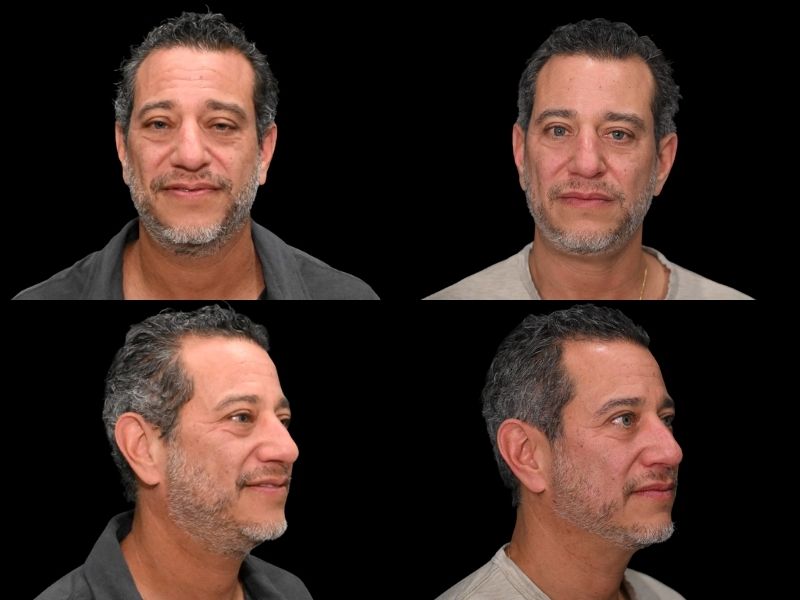 eyelid surgery before and after chicago
