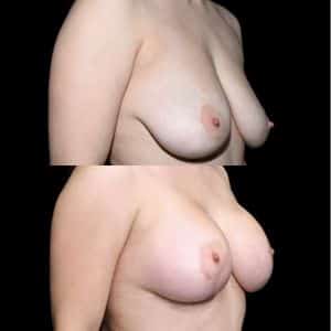 Breast Lift Chicago Before and After