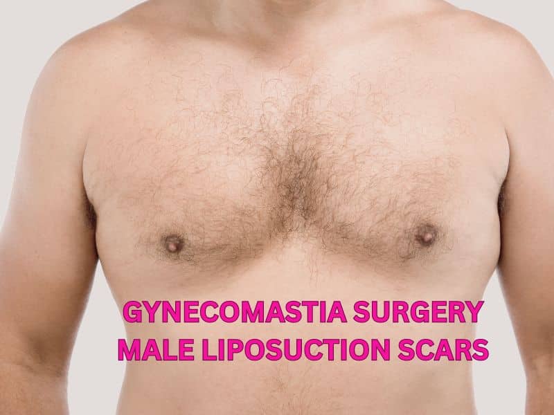 gynecomastia surgery male liposuction scars