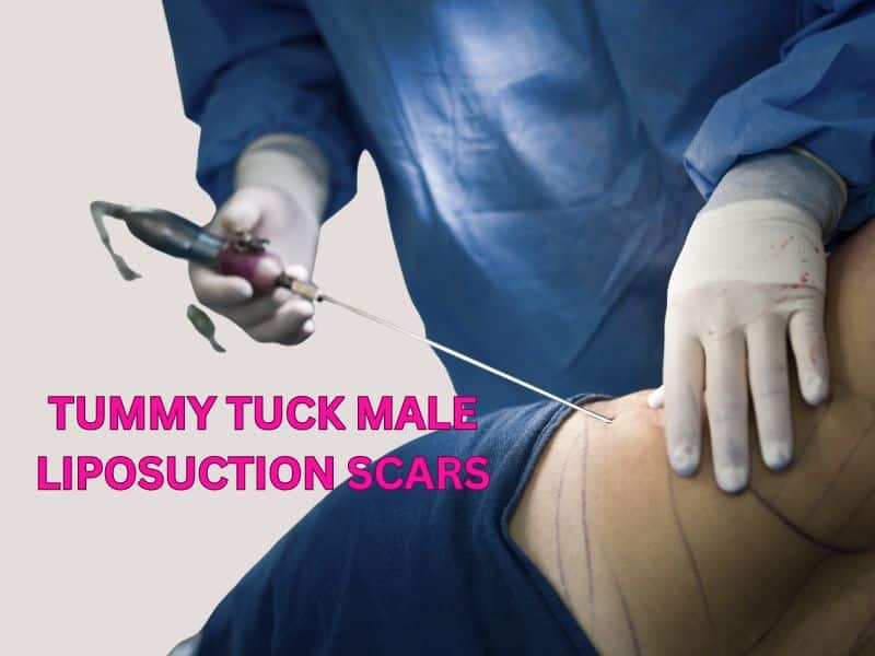 tummy tuck male liposuction scars