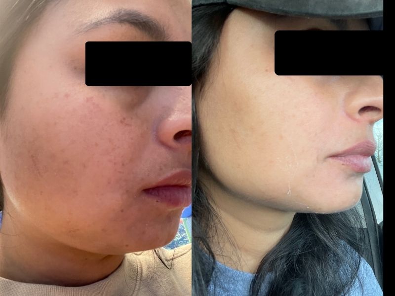 vi peel before and after chicago